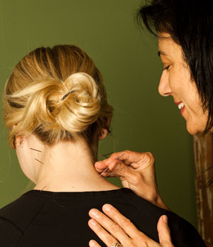 Acupuncture treatment by Dr. Shahnaz Sabeti